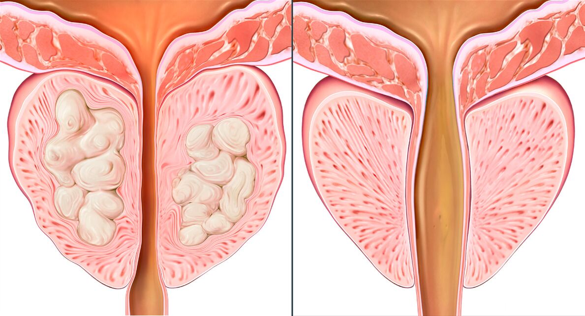 Etape de curs tratament pentru prostatita cu Prostalix
